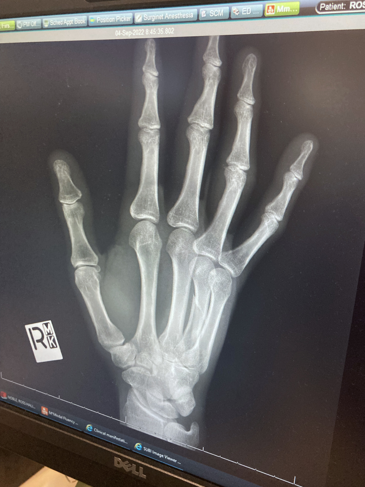 Broken hand